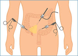 Laparoscopic appendectomy