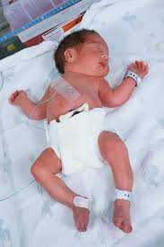 Image result for Preterm Infant