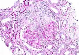 Image result for Microscopic Polyangiitis