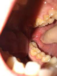 Canker Sore Near Wisdom Tooth Is So Damn Painful I Can Barely Breathe Without Needing Advil Started Friday How Much Longer Should The Pain Last Cankersores
