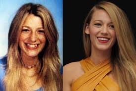 22 мая 20171 573 просмотра. 13 Fake Teeth Celebs Before And After Rhinoplasty Nose Jobs Celebrities Celebs