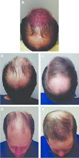 In the regular norwood pattern, two areas of hair loss gradually enlarge to produce recession at the temples and thinning in the crown. This 38 Year Old Man With Male Pattern Hair Loss Requested Hair Download Scientific Diagram