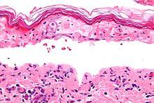 Therapist education & personal consultation. Stevens Johnson Syndrome Wikipedia