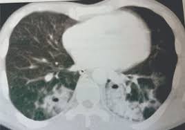 Image result for Pulmonary Contusion