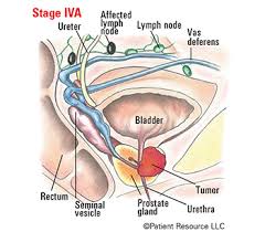 Rounded masses of tissue that produce cells to fight invading germs or cancer. Patient Resource Publishing Prostate Cancer Staging