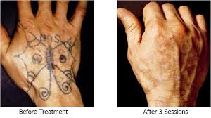 Because there are so many different tattoos ranging in shapes, sizes, colors, and more it is hard to predict an exact amount of treatments that will be needed, but it normally ranges from 6 to 12 sessions to completely remove a tattoo. Tattoo Removal Back To Blank