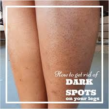 How To Get Rid Of Dark Spots On Your Legs A K A Strawberry Legs Dark Pores Strawberry Legs Dark Spots On Legs
