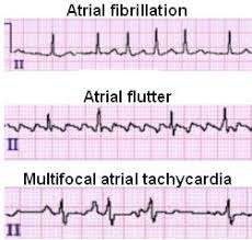 Atrial Fibrillation Topic Review Learntheheart Com