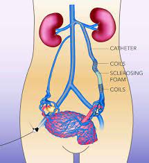 Pelvic Congestion Syndrome Causes Symptoms Diagnosis Treatment