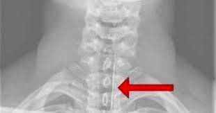 L Astuce Pour Faire Passer Une Arete Coincee Dans La Gorge Astuces De Grand Mere Astuces Remedes De Sante Faire Soi Meme