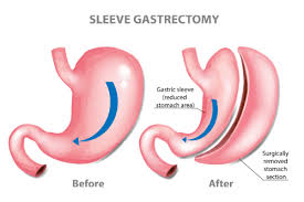 gastric sleeve procedure for weight