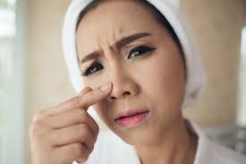 Cuma kita je tak tau. 9 Cara Menghilangkan Blackhead Yang Disarankan Ahlinya Bag 1