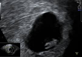 Ssw 4 5 Keine Fruchthohle Sichtbar Babyforum At
