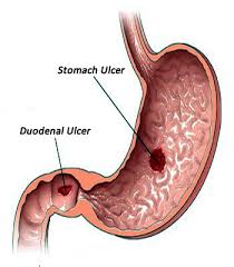 An ulcer can be defined as a break in the continuity of the skin or mucous lining due to multiple reasons such as acid overload, drug abuse, stress, and infections. Stomach Ulcers The Causes Symptoms Diagnosis Treatment Diet Home Remedies Prevention And When To Call Your Doctor