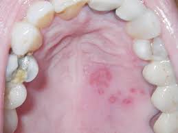 Image result for Oral herpes roof of mouth