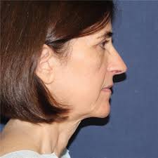 Facelift Before and After Photos by Brian Windle, MD; Aspen, CO