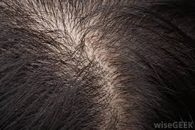 Other causes of hair loss regardless of whether you have sores on head comprise the following things. What Are The Different Types Of Scalp Infections