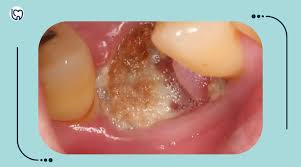 Image result for Dry Socket