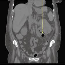 Image result for Perinephric Abscess