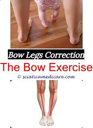 Permanent Remedy For Bow Legs What Makes A Baby Bow Legged What Is Bow Legged What Does It Mean To Be Bow Legged Bow Legged Correction Bow Legged Knock Knees