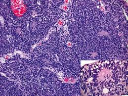 10 many retinoblastomas have underlying elements of retinoma. Canine Globe Retinoblastoma Like Tumor Case No 1 Cases Displaying Download Scientific Diagram