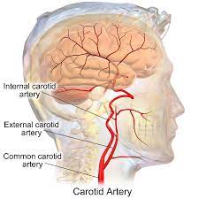 Coronary arteries, the carotid arteries in the neck, and renal (kidney) or biliary (gall bladder) when a person has a stroke it can be from blockage in 1 or both of the carotid arteries in the neck. Internal Carotid Artery Wikipedia