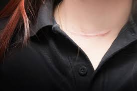 It is the most common cancer diagnosed in women aged diagnoses of thyroid cancer in australia have increased in recent years. Thyroid Cancer Hearing The Diagnosis Preparing For Surgery And Recovery