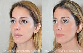 Can you get rid of a bulbous nose without surgery? Rhinoplasty Before After Photos Beverly Hills La Rhinoplasty