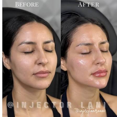 Face Contouring Approaches: Achieving Natural Results