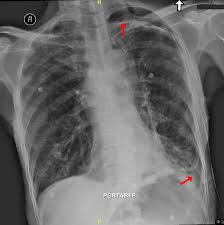 The degree of collapse determines the clinical presentation of pneumothorax. A Routine Chest X Ray Shows An Incidental Left Sided Apical And Basal Download Scientific Diagram