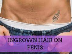 Visual representation is available in these pictures of ingrown hair on penile shaft. 22 Shaving Ideas Ingrown Hair Essential Oil For Bronchitis Shaving