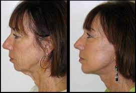 A Reason To Be Thankful Turkey Neck Treatments That Work California Skin Institute