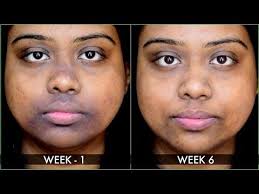Apply as a mask and leave on for half an hour. How I Got Rid Of Pigmentation Sun Tan Around Mouth With Diy Face Pack 100 Result Within 10 Days Dark Skin Around Mouth Diy Face Pack Pigmentation Remedy