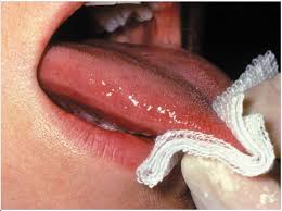Image result for papillomavirus tongue)