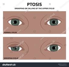 Image result for Proptosis