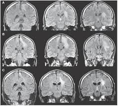 A Case Of Celiac Disease Mimicking Amyotrophic Lateral Sclerosis Nature Reviews Neurology