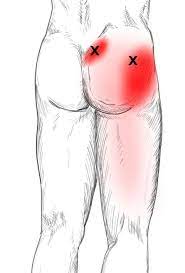 Piriformis Schmerzen Triggerpunkte Selbst Behandeln