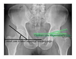 Image result for Hip XRay