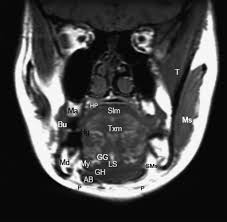 In morphologic and functional terms, the biceps femoris muscle is considered to be a double muscle, with the long head arising from the medial facet of the ischial tuberosity (, fig 2,) and the short head arising from the lateral linea aspera, lateral supracondylar line, and intermuscular septum.the short head is the only component of the hmc that does not span two. Coronal T1 Mri Of Normal Oral Cavity Anatomy Ab Indicates Anterior Download Scientific Diagram
