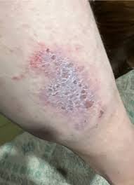 Image result for Lichen Simplex Chronicus