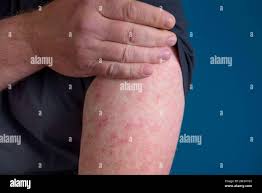 Image result for erysipel photos)