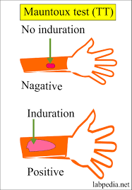 A positive ppd test means that, at some point, you were exposed to tb. Mycobacterium Tuberculosis Part 2 Mantoux Test Tt Tuberculin Skin Test Labpedia Net