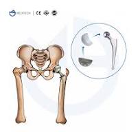 Orthopedic Implants Titanium Bipolar Hip Prosthesis Femoral Stem Implant
