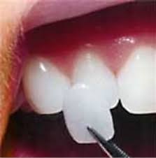 At times, more than one visit is necessary in order to get the job done effectively and. Beautiful Porcelain Veneers Dental Veneers In Libertyville