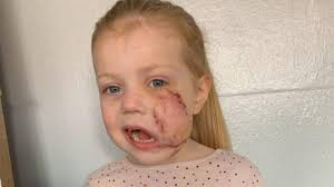 XL bully: Mum of girl, 4, attacked by dog says 'dangerous' breed should be  banned