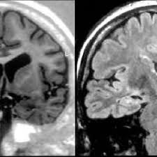 Antonio robles gentile médico c.c., centros asistenciales getafe y pinto correspondencia: Esclerosis Temporal Mesial Y Hemiatrofia Cerebral Izquierdas Caso 9 Download Scientific Diagram
