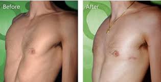 Its symptoms can affect people physically and psychologically. Pectus Excavatum Nicklaus Children S Hospital