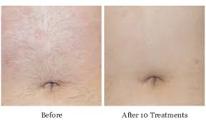 Treatments take an average of two to three minutes and are scheduled approximately four weeks apart. Laser Hair Reduction Abdomen The Skin Laser Boutique