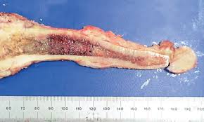 Image result for Osteosarcoma