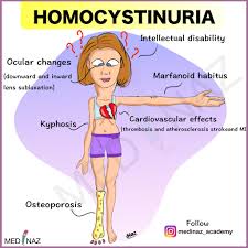 Image result for Homocystinuria